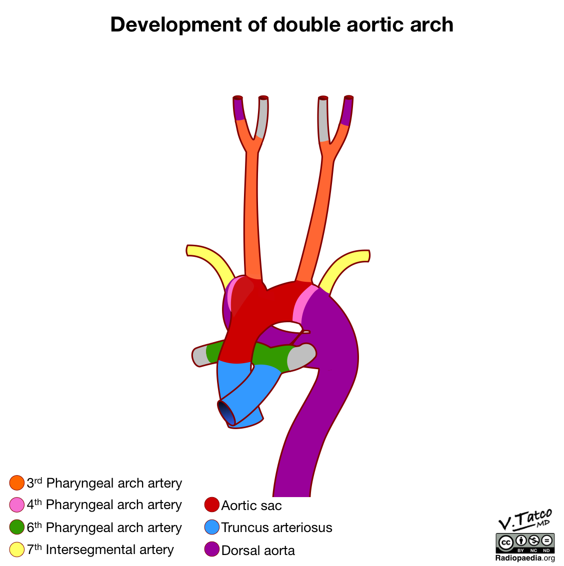 Radiopaedia Drawing Development of double aortic arch no